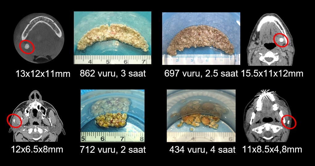 Sialendoskopi ve kanal içi tükürük bezi taşı kırma çalışması
