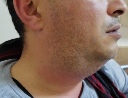 Az su tüketimi tükürük bezi taşı oluşumuna neden olabilir!