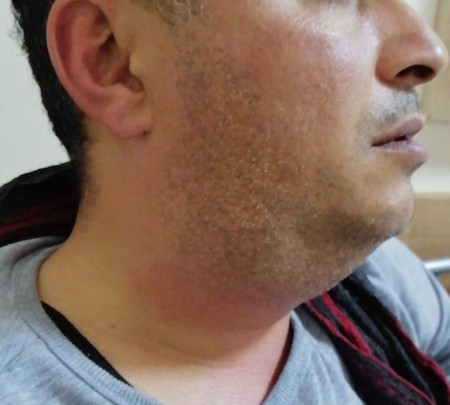 Tükürük bezi taşı nedeniyle sağ çene altı bölgede iltihaplanma ve abseleşme.