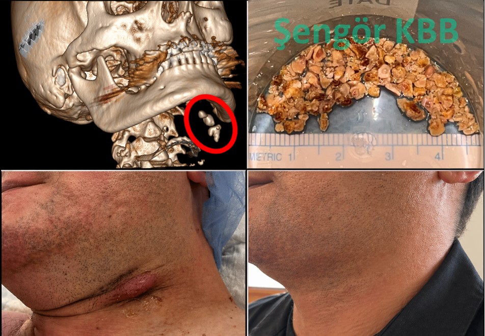 cilde-fistul-acilmis-3-tasli-komplike-vaka