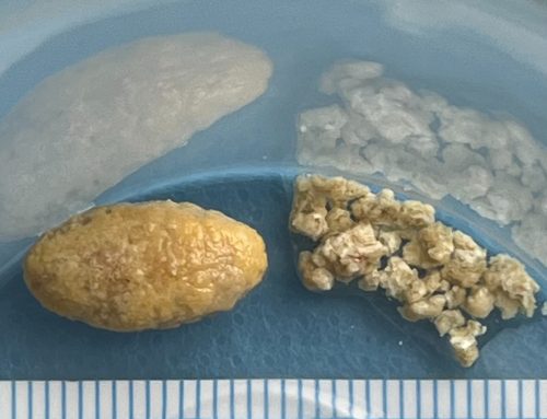 Tükürük Bezi Taşı: Dikkat Edilmesi ve Sorgulanması Gereken Durumlar